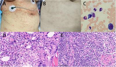 Case report: Systemic multi-organ involvement in an adult-onset immunodeficiency patient infected with Talaromyces marneffei